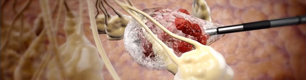 Cryoablation Treatment Banner